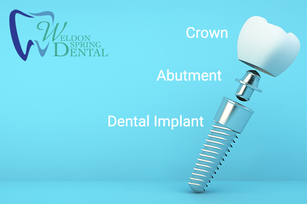Dental Implants | Implants | Dental Implants Near Me | Weldon Spring Dental