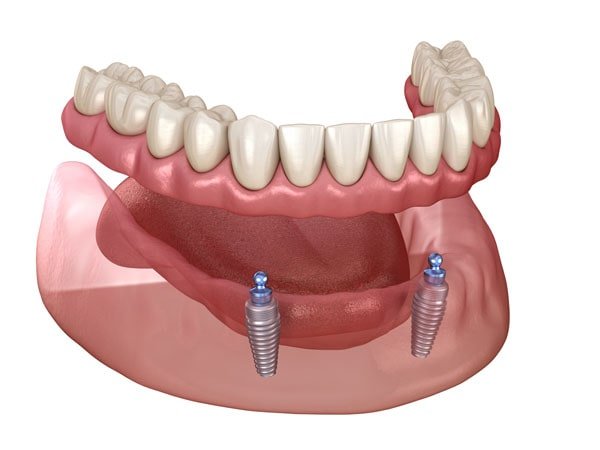 Implant dentures weldon spring dental